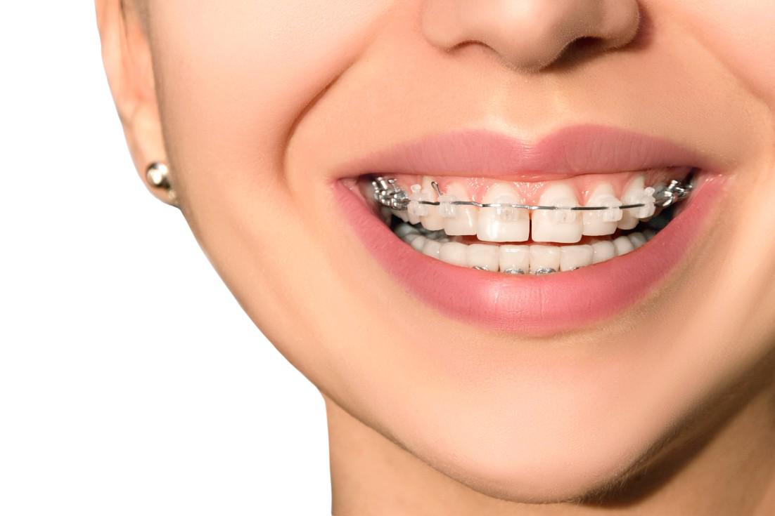 Closing Gaps in Teeth with Braces