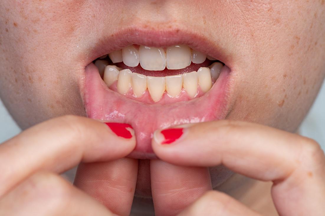 Gum Recession – Recognizing Signs and Taking Action