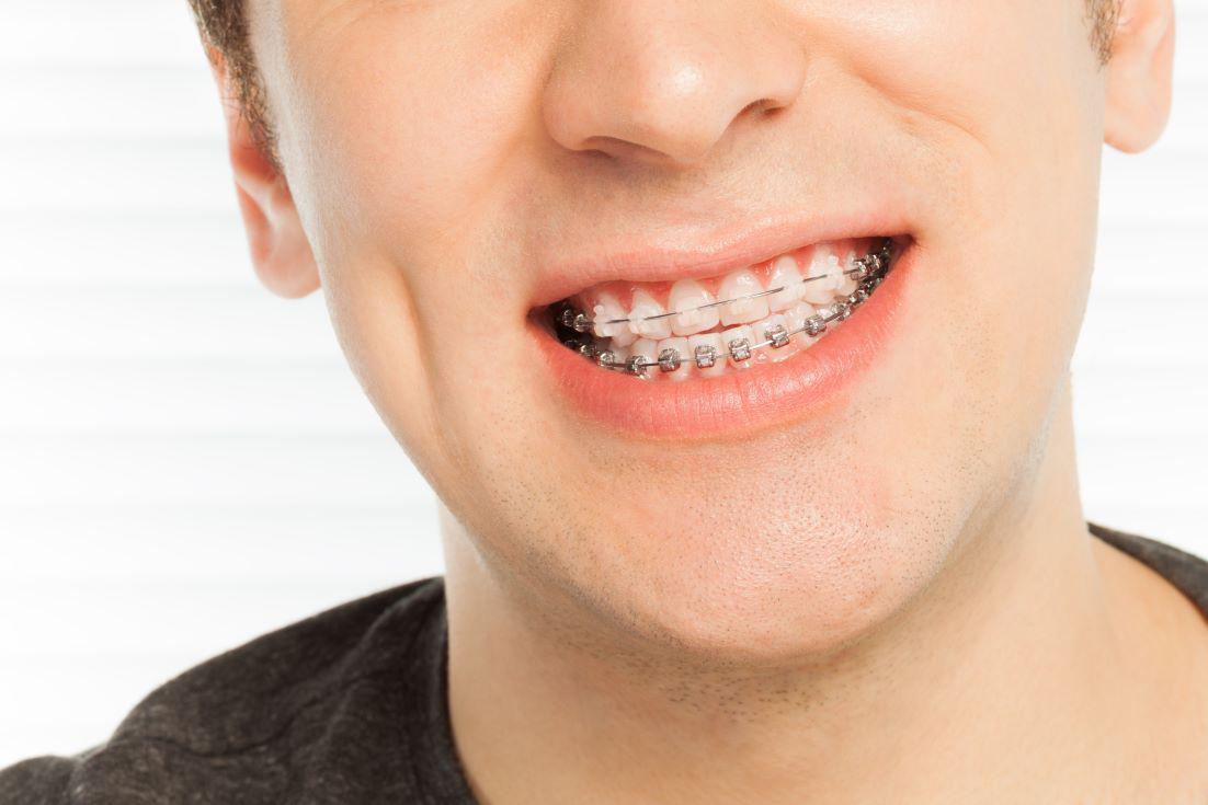 Clear Aligners vs. Traditional Braces