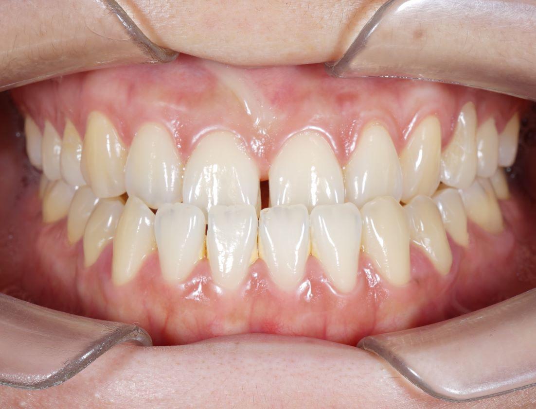 What is a Crossbite? Signs and Treatment